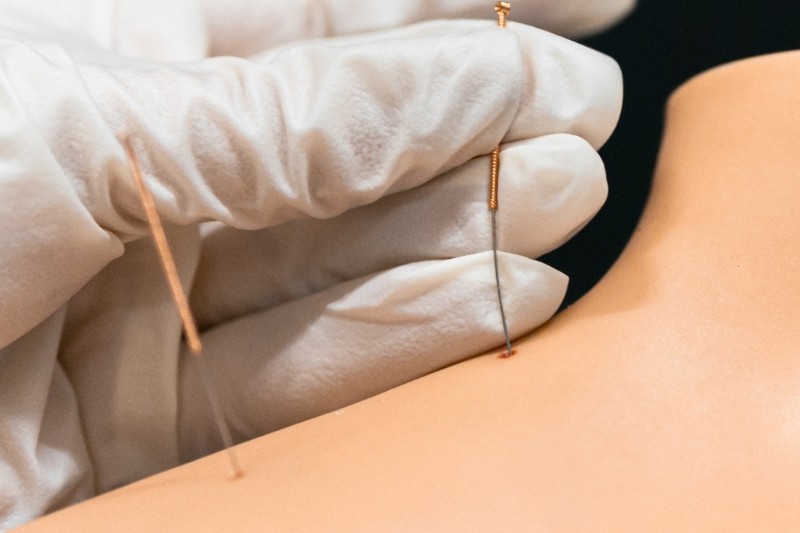 placing acupuncture needles