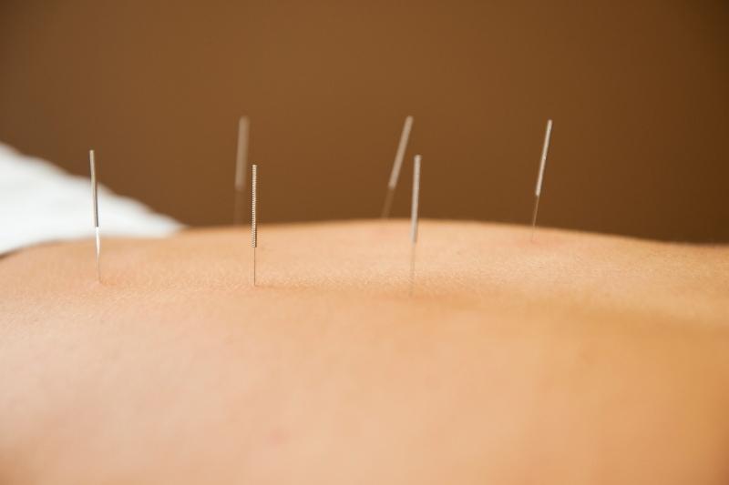 acupuncture needles in the back