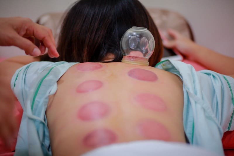 red skin from cupping therapy